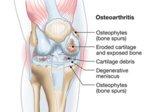 OA of the knee diagram